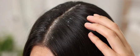 Tea tree oil mot mjäll: Så får du naturlig lindring