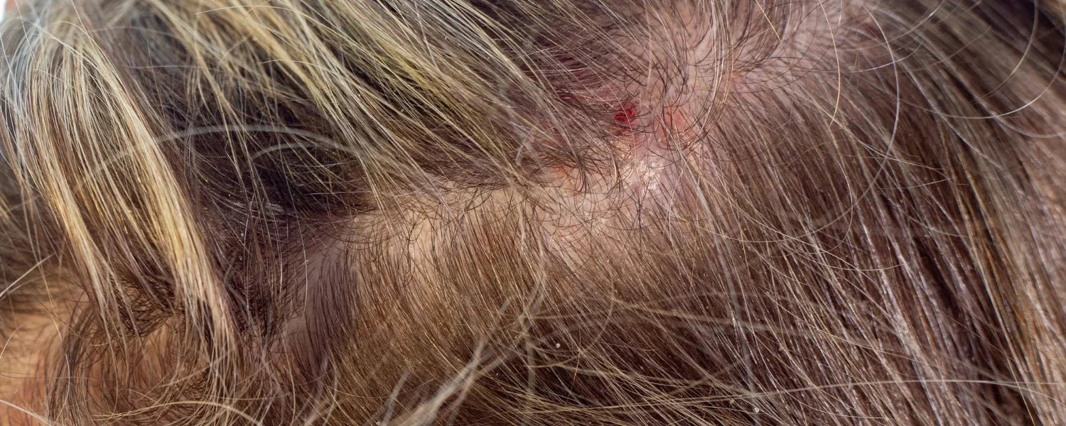inflammation i hårbotten